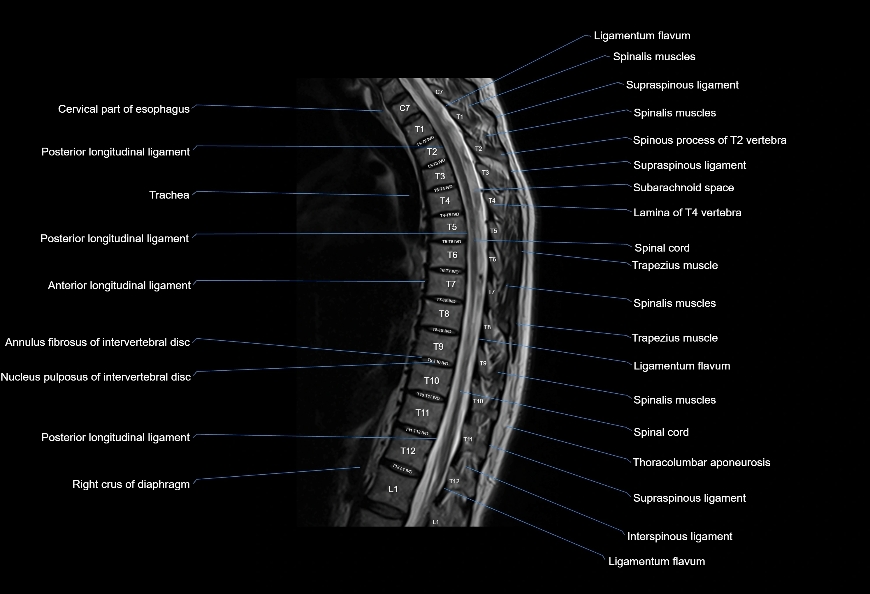 MRI thoracic spine sagittal  cross sectional anatomy 3T radiology  image-img-00001-00011.webp